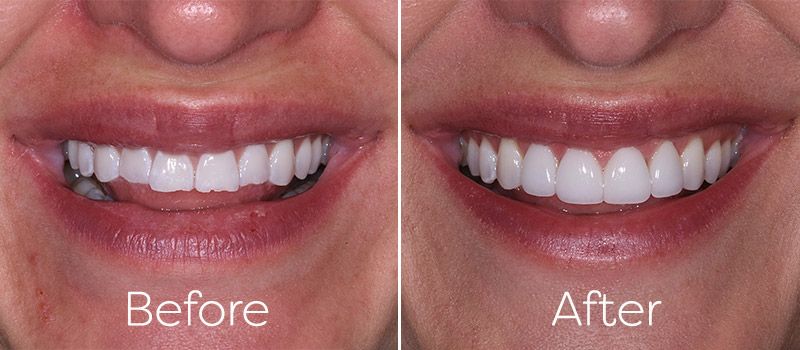 Ceramic Veneers before and after