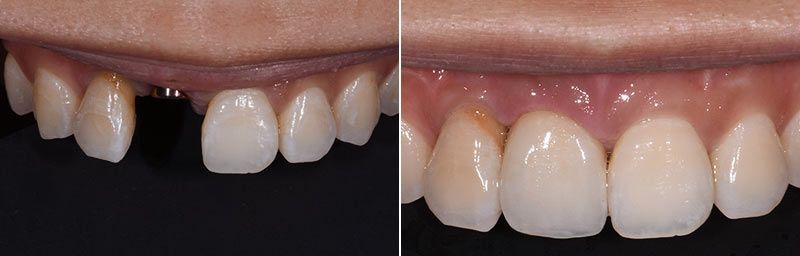 Dental Implant Crown Tooth