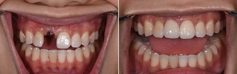 Dental Implant Crown Tooth