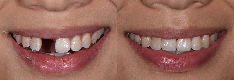 Dental Implant Crown Tooth