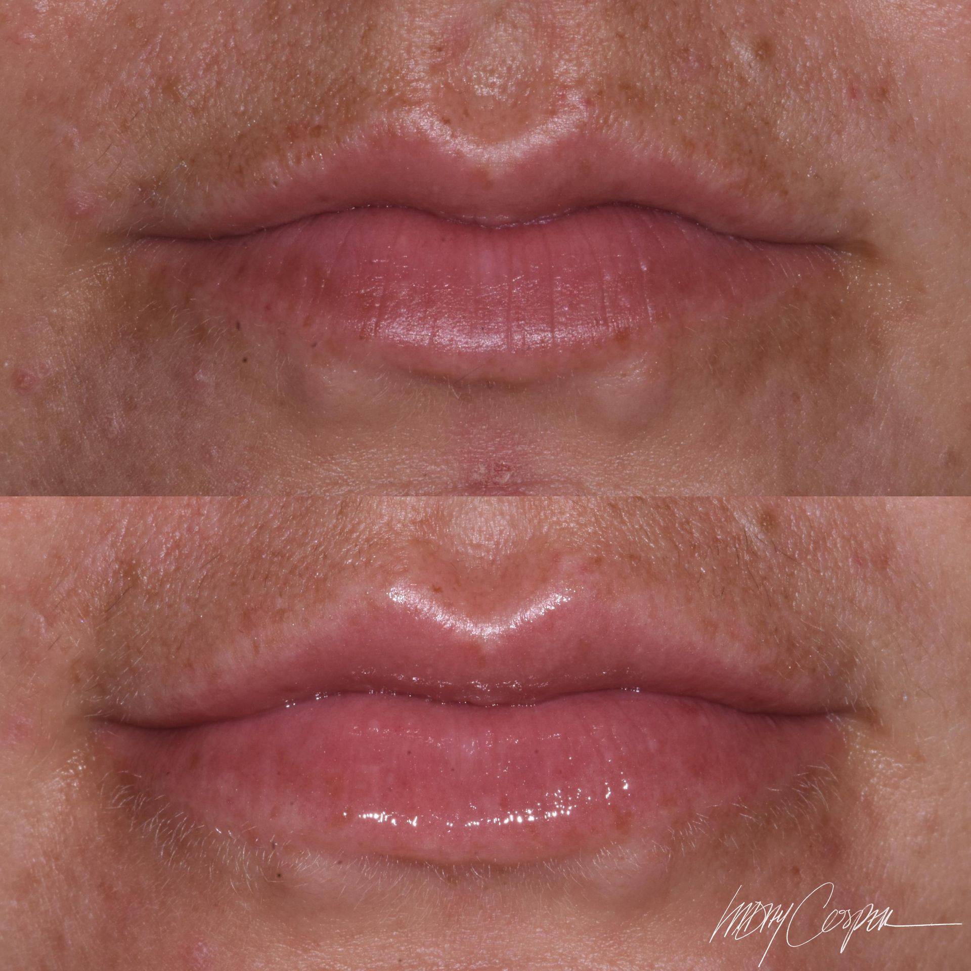 Botox before and after