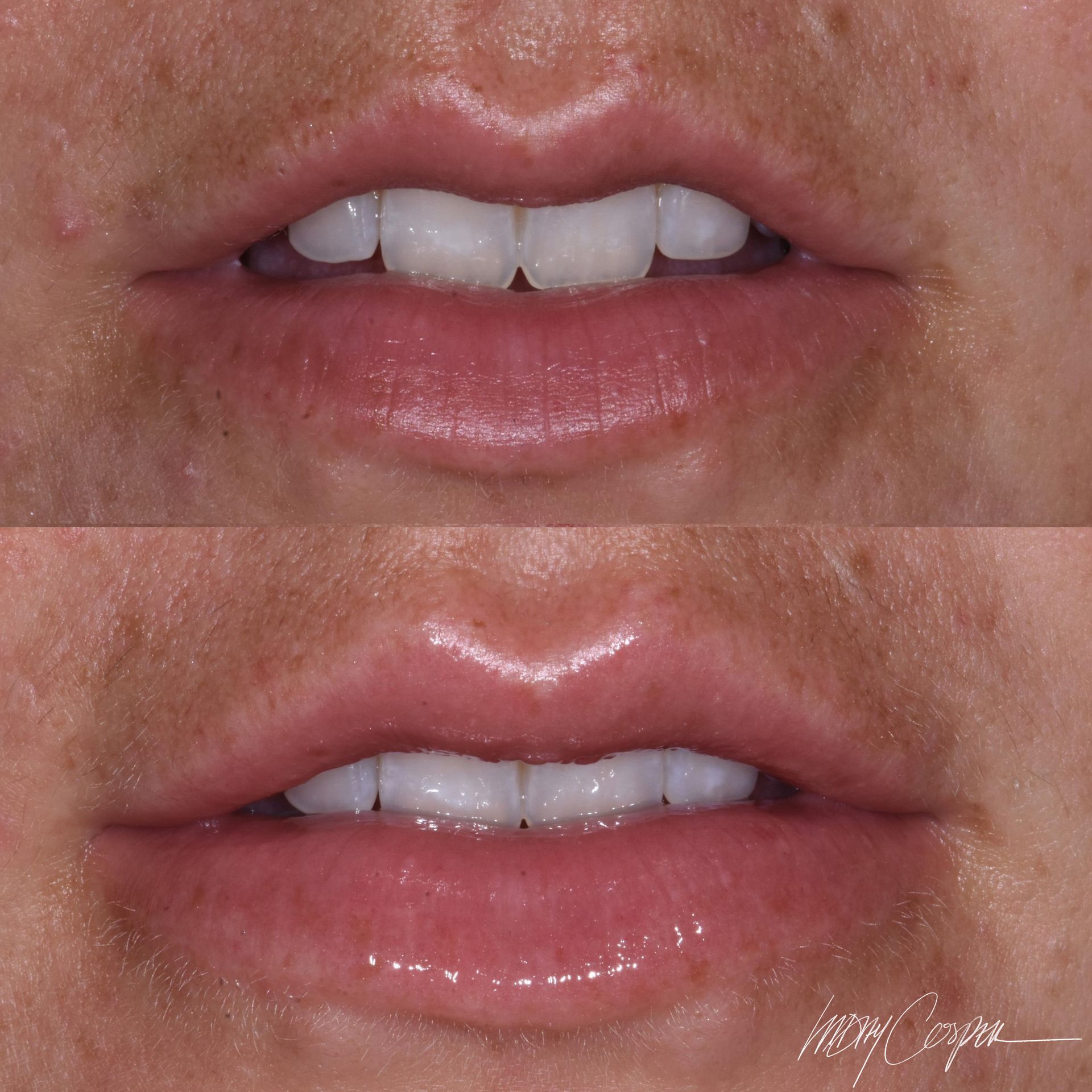 Botox before and after