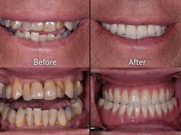 A before and after photo of a man 's teeth.