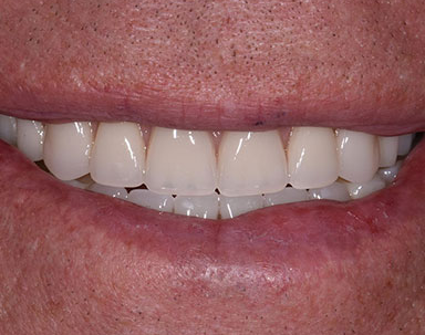 Maxillary Fixed Hybrid Overdenture