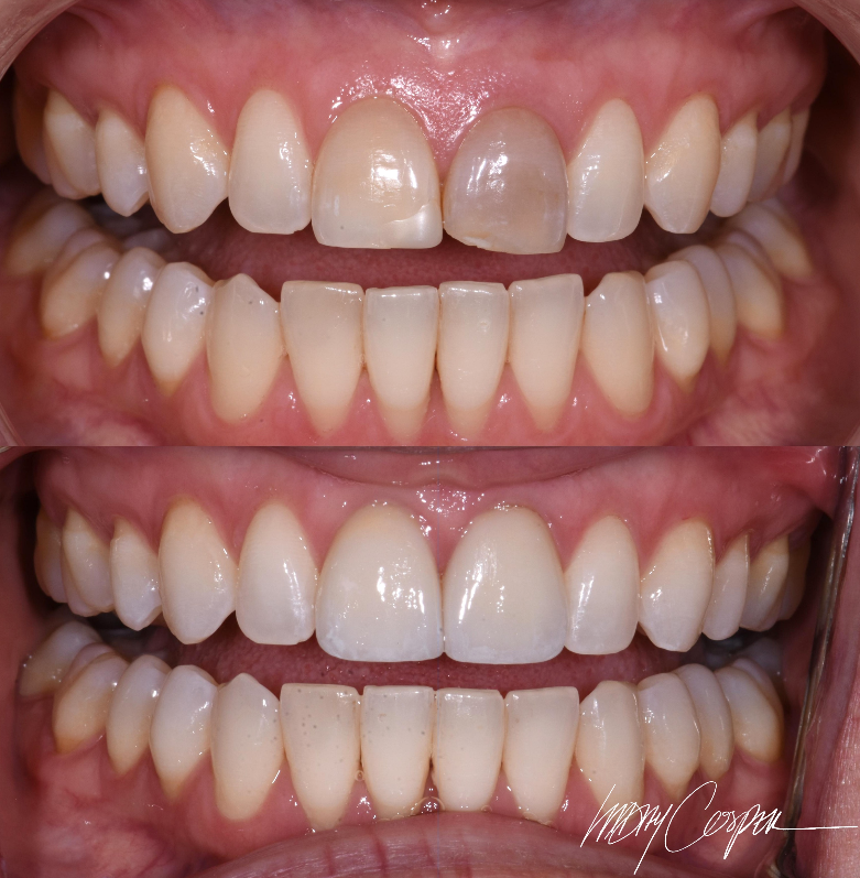 Smile makeover before and after with Invisalign internal external bleaching ceramic veneers Fort Collins CO