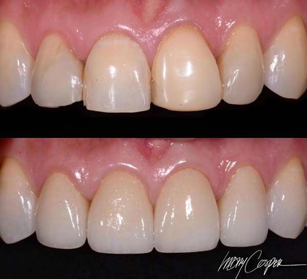 Veneers Fort Collins