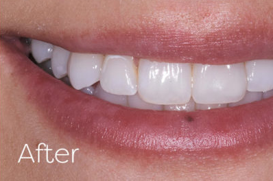 Composite Restorations