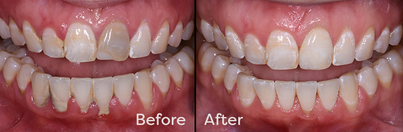 tooth whitening fort collins
