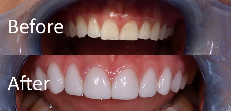 Porcelain Veneers