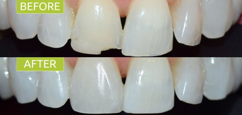 Single Tooth Composite Veneer