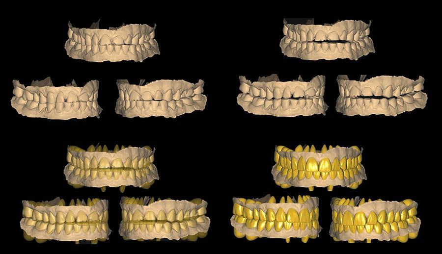 Smile Makeover