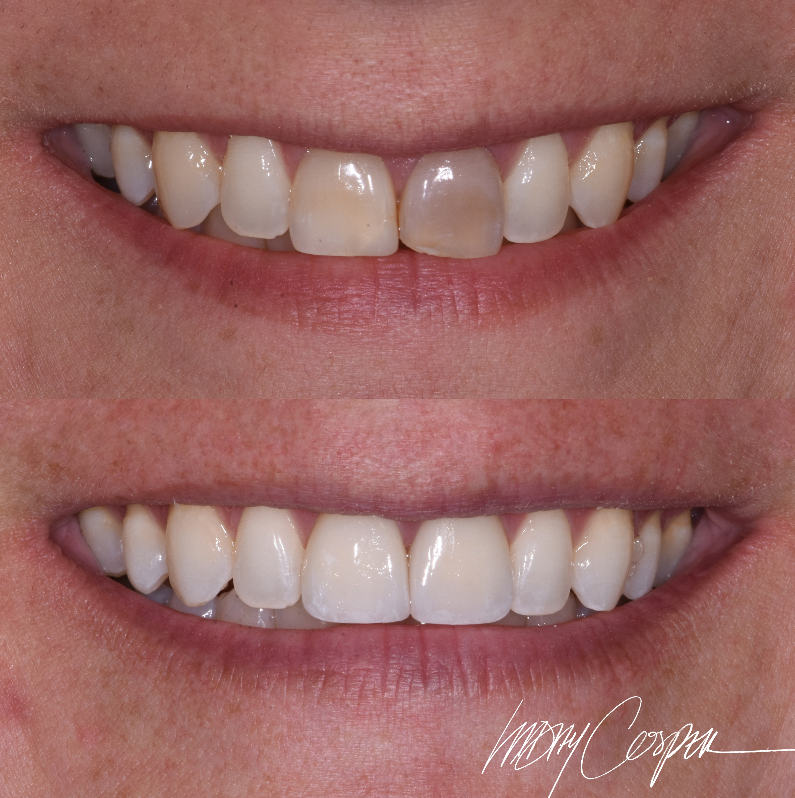 Before and after minimally invasive smile makeover Fort Collins – Invisalign, bleaching and ceramic veneers