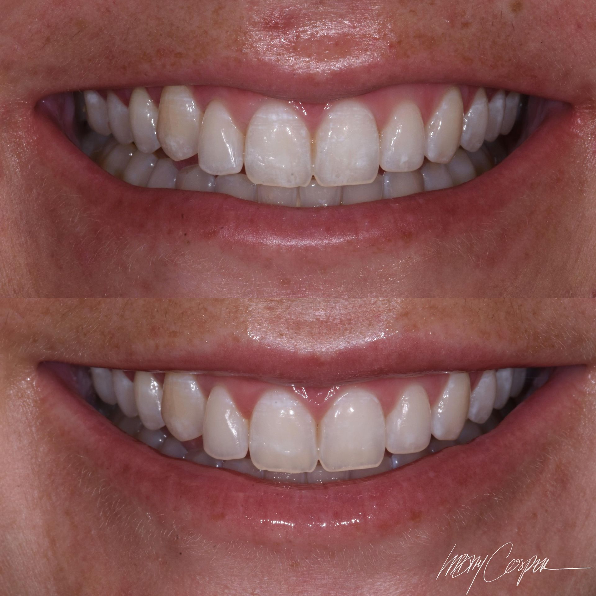 Botox before and after