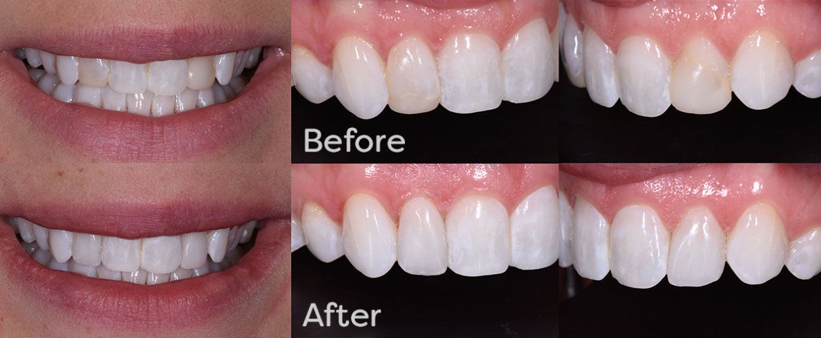 Non-Invasive Composite Veneer Restorations