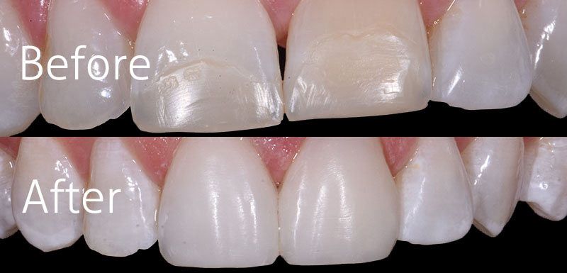 Tooth Whitening Composite Veneers