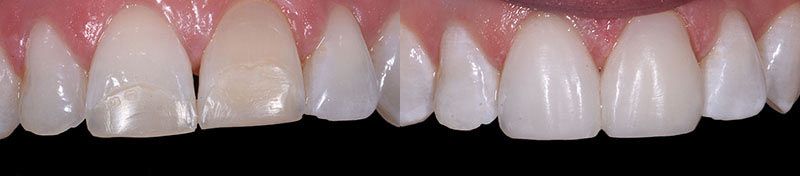 Tooth Whitening Composite Veneers