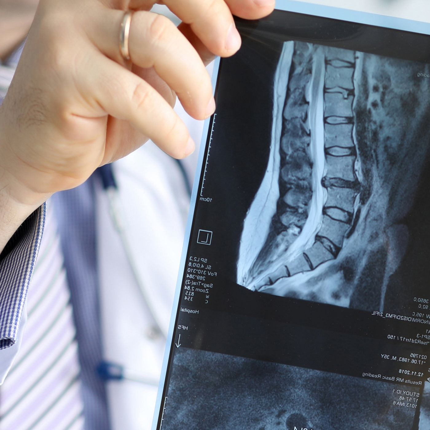 Person holding a medical X-ray film with a visible spine scan