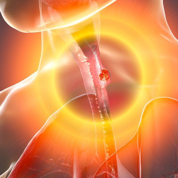 Abstract orange medical illustration showing blood vessel blockage in a vein