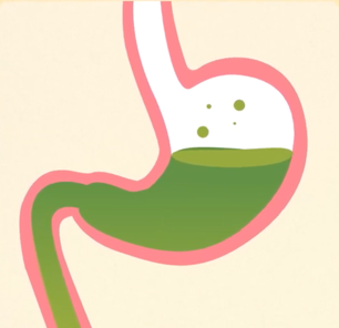 Gastroparesis causes the stomach muscles to work poorly or not at all, resulting in a stomach that does not empty properly