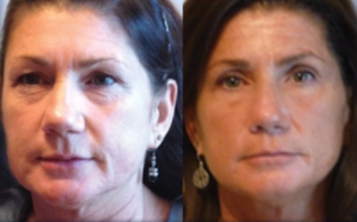 A before and after photo of a woman who used the NeurotriS Pico Toner at home.