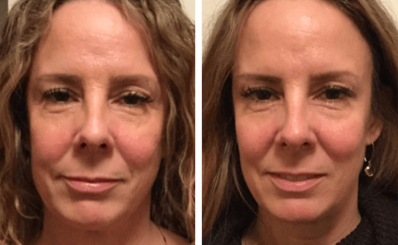 A before and after photo of a woman 's face