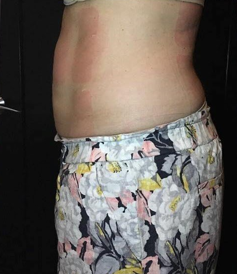Abdomen profile after NeurotriS Body treatments for inch loss and toning.