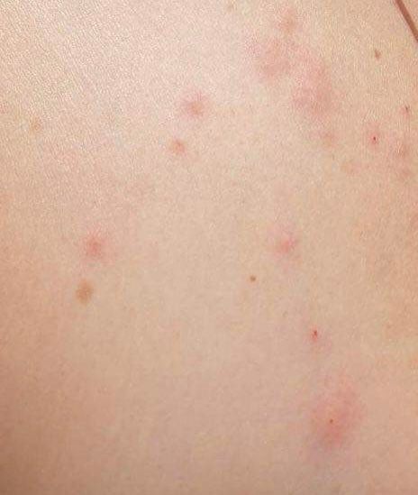 Une recrudescence alarmante des punaises de lit : les experts tirent la sonnette d'alarme dans les yvelines
