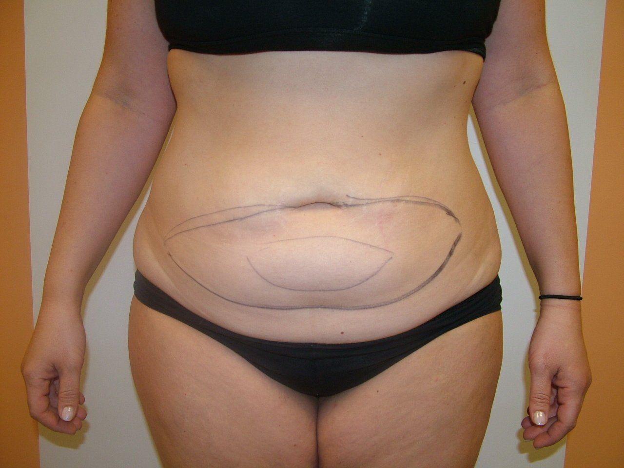 liposuction near brick nj