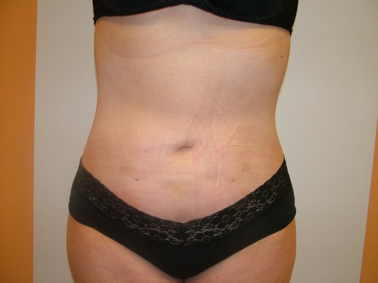 smart liposuction brick nj