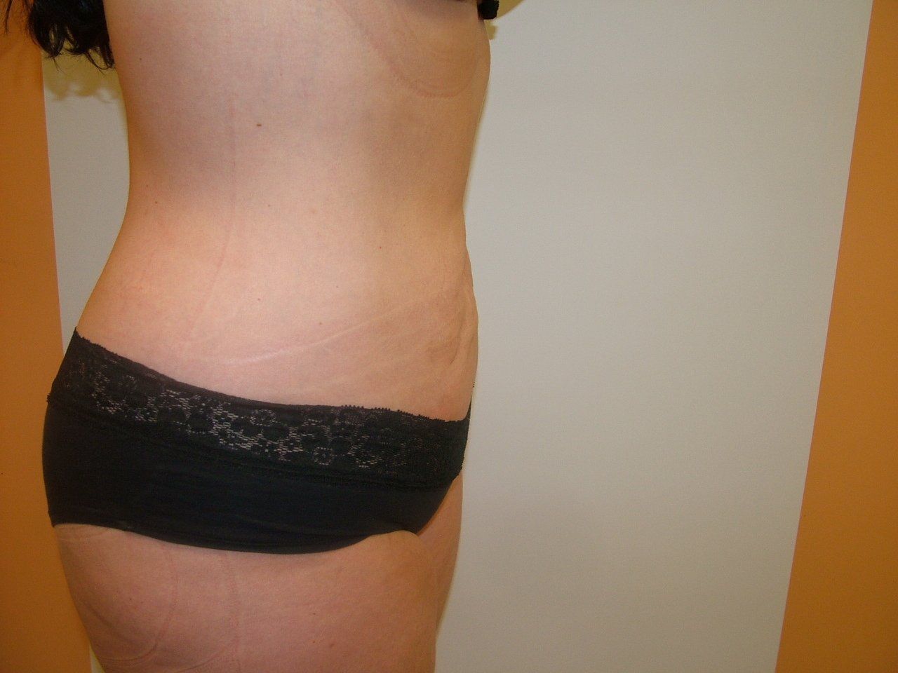 Side view of a person's torso and lower abdomen in black underwear. There are stretch marks and a plain wall behind.