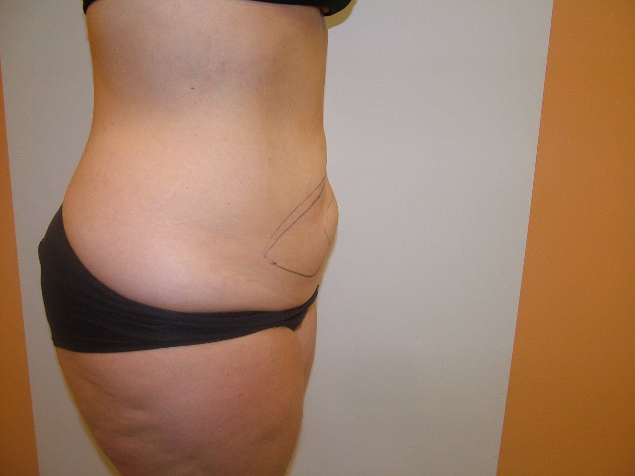 Profile view of a person's torso and hip. Black undergarment. Outlined area on abdomen. Tan skin, simple background.