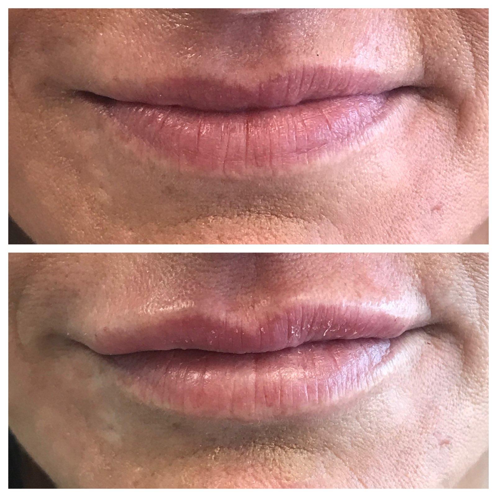 Comparison of lips: top image shows thin lips, bottom image fuller lips, likely from a procedure.