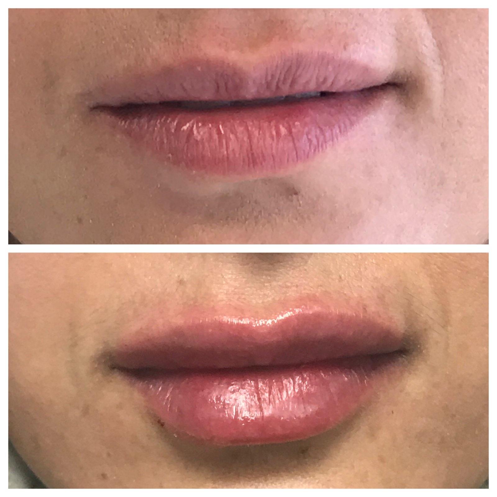 Before and after comparison of lip augmentation: top, thinner lips; bottom, fuller lips.
