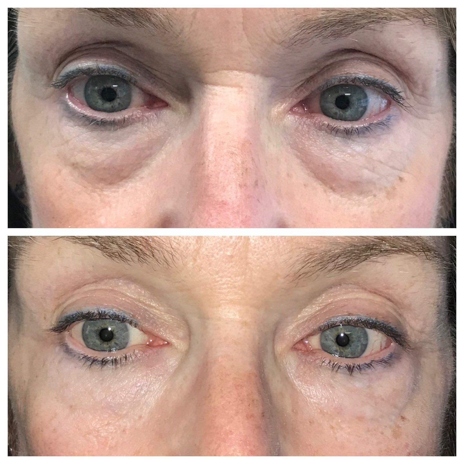 Two side-by-side close-up views of eyes, showing under-eye bag reduction. Top view: before; bottom: after.