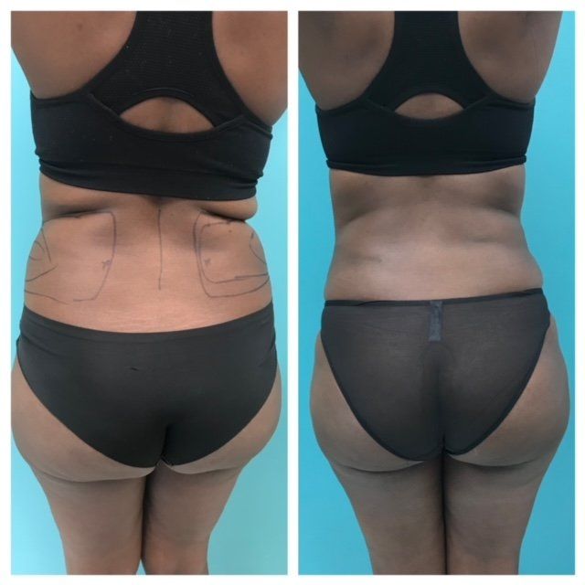 Side-by-side comparison of a person's back before and after a body contouring procedure, showing reduced fat and improved shape.