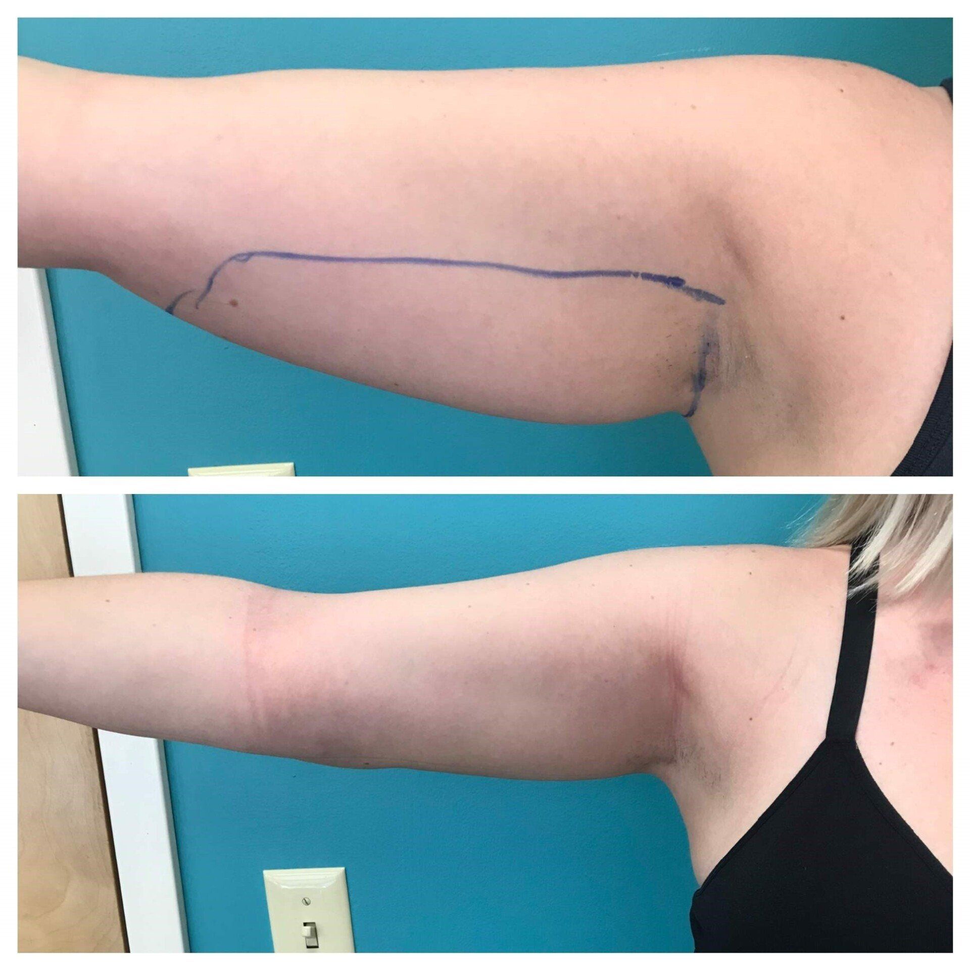 Two photos of an arm before and after surgery. The top photo shows excess skin marked with a blue pen. Bottom photo shows a smoother arm.