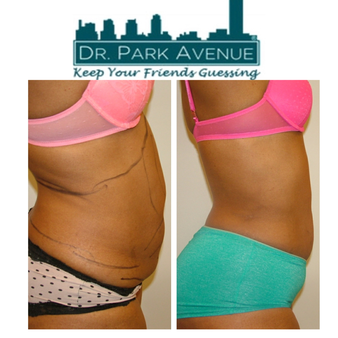 Before and after abdominal procedure: side view. Pink bra, green shorts. Smoother skin post-op.