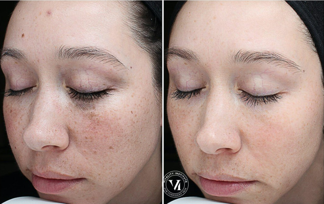 Side-by-side view of a person's face. Left side shows skin with spots, right side shows clearer skin.