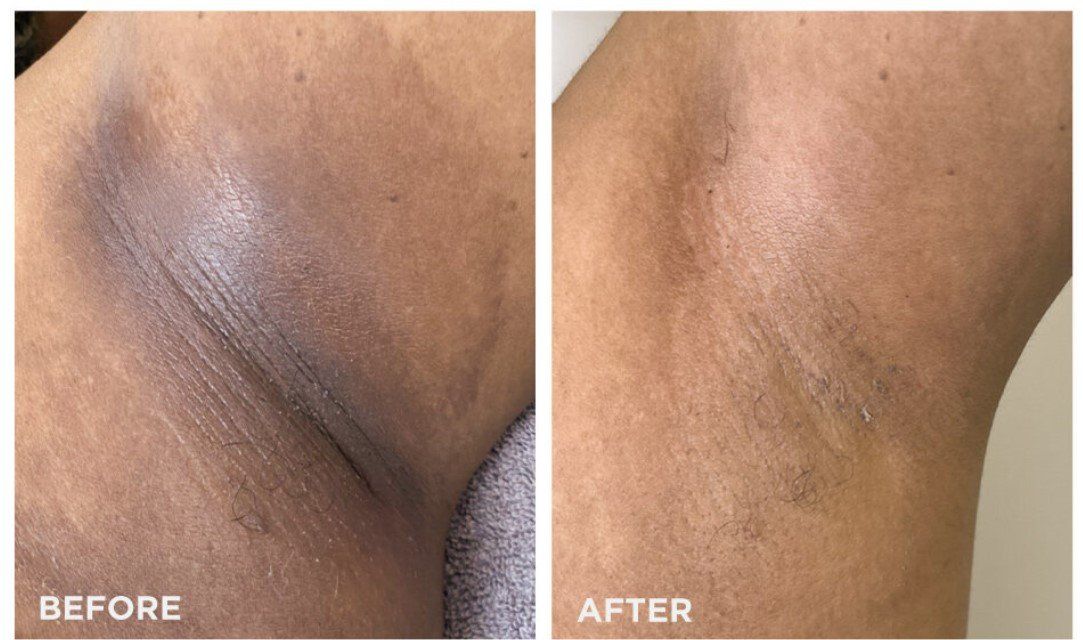 Before and after comparison of an armpit, showing reduction in darkness.