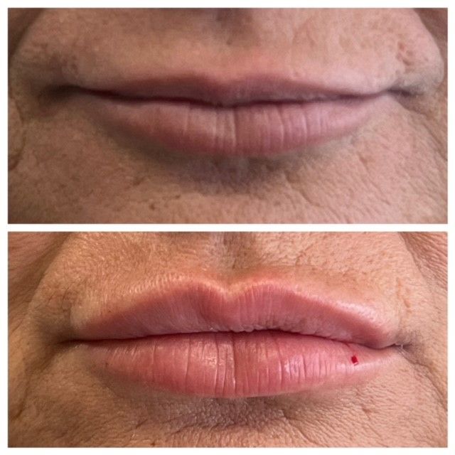 Comparison of upper and lower lip before and after lip filler treatment.