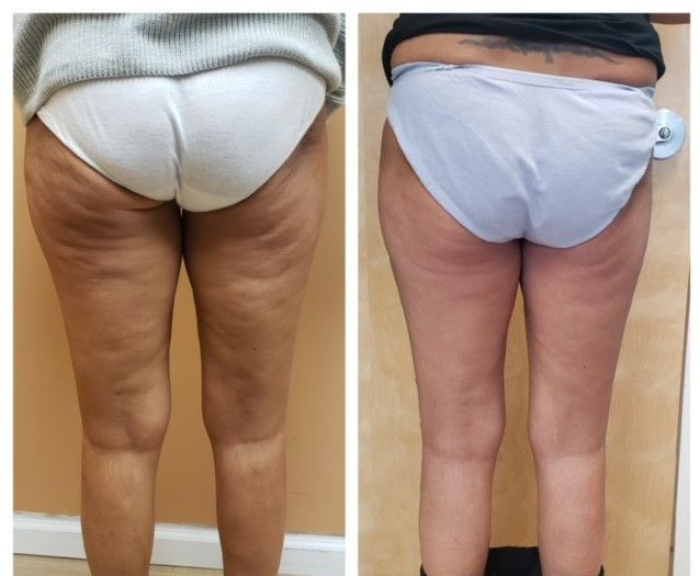 skin tightening brick new jersey