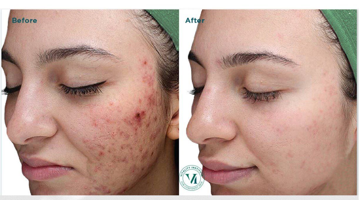 Before and after photos of a person's face showing reduction of acne and improved skin.