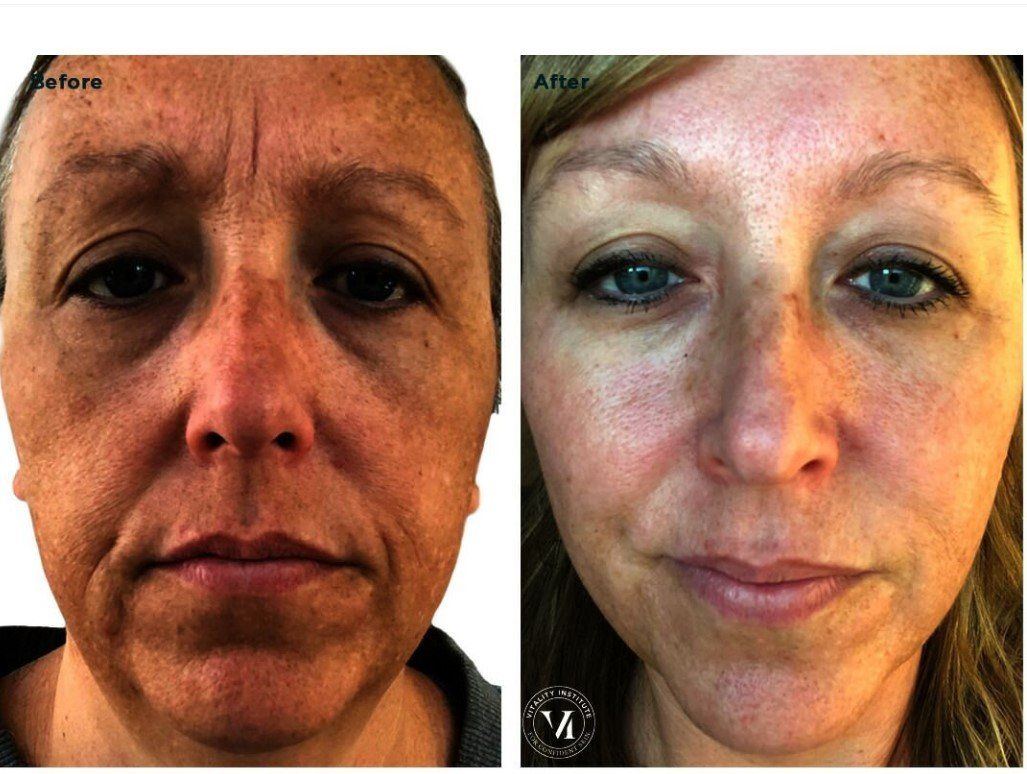 Before and after photos of a person's face, showing a reduction in wrinkles and improved skin tone.