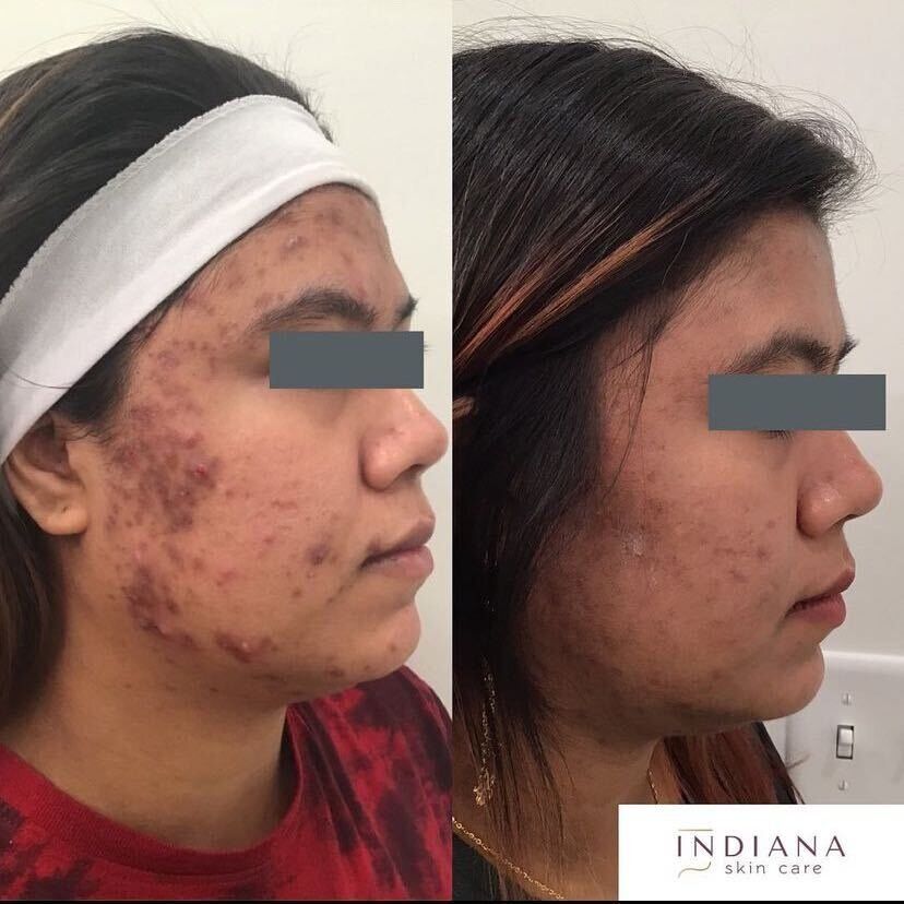 Before and after comparison of a person's face showing acne reduction; profile view.