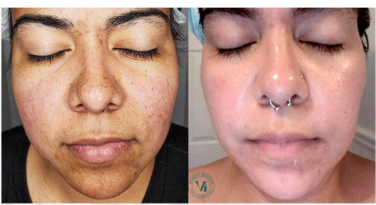 Side-by-side comparison of a person's face. Left side: skin with dark spots. Right side: smoother, glowing skin.