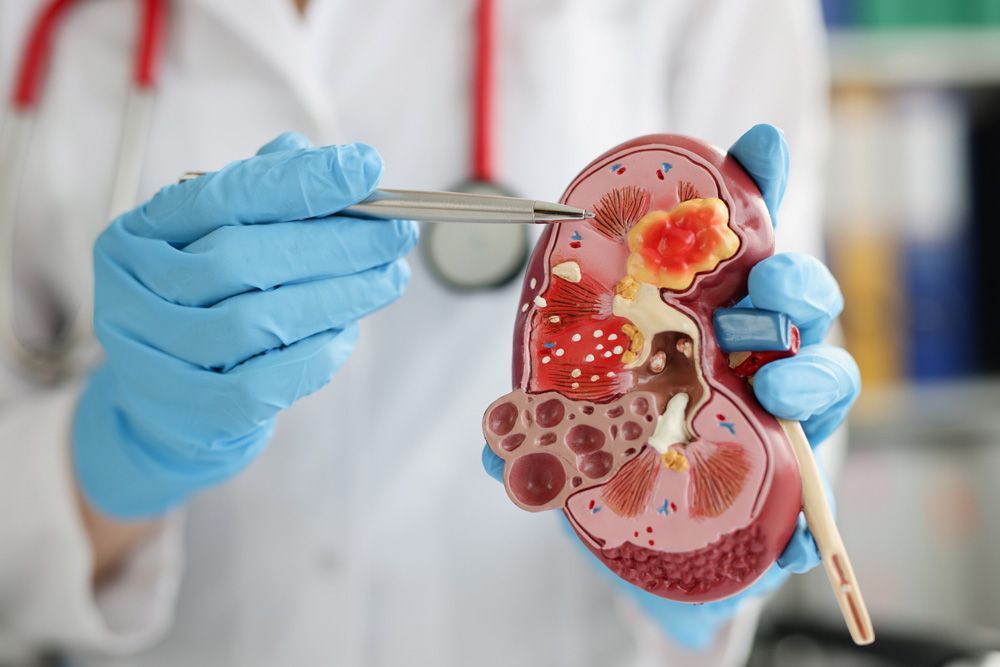Kidney Stone — Rockford, IL — Rockford Nephrology Associates