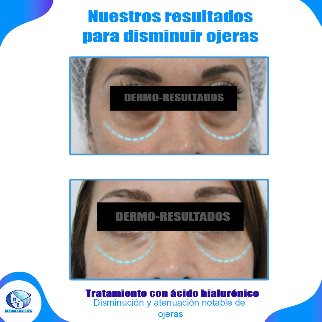 Una fotografía de antes y después del rostro de una mujer con las palabras 