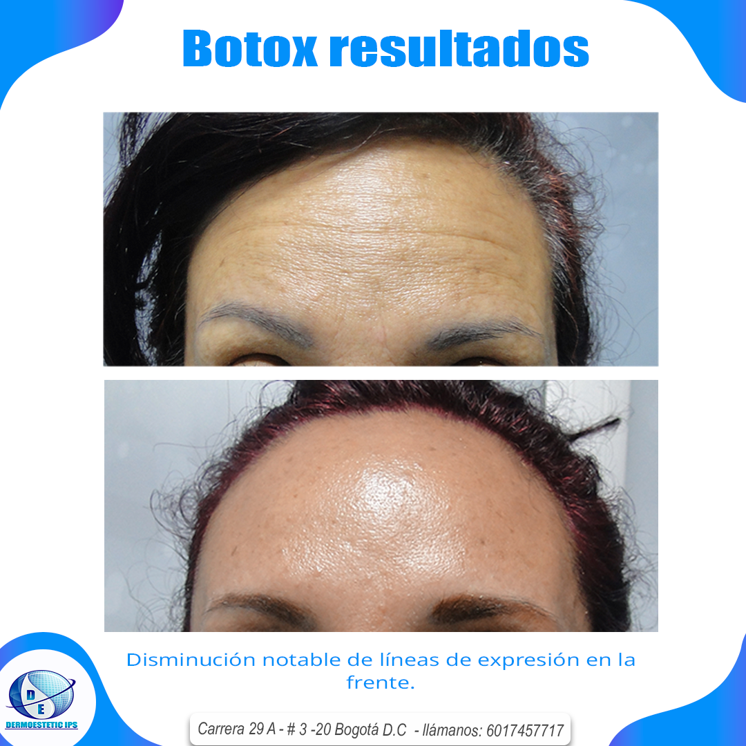 Una foto de la frente de una mujer antes y después del botox.
