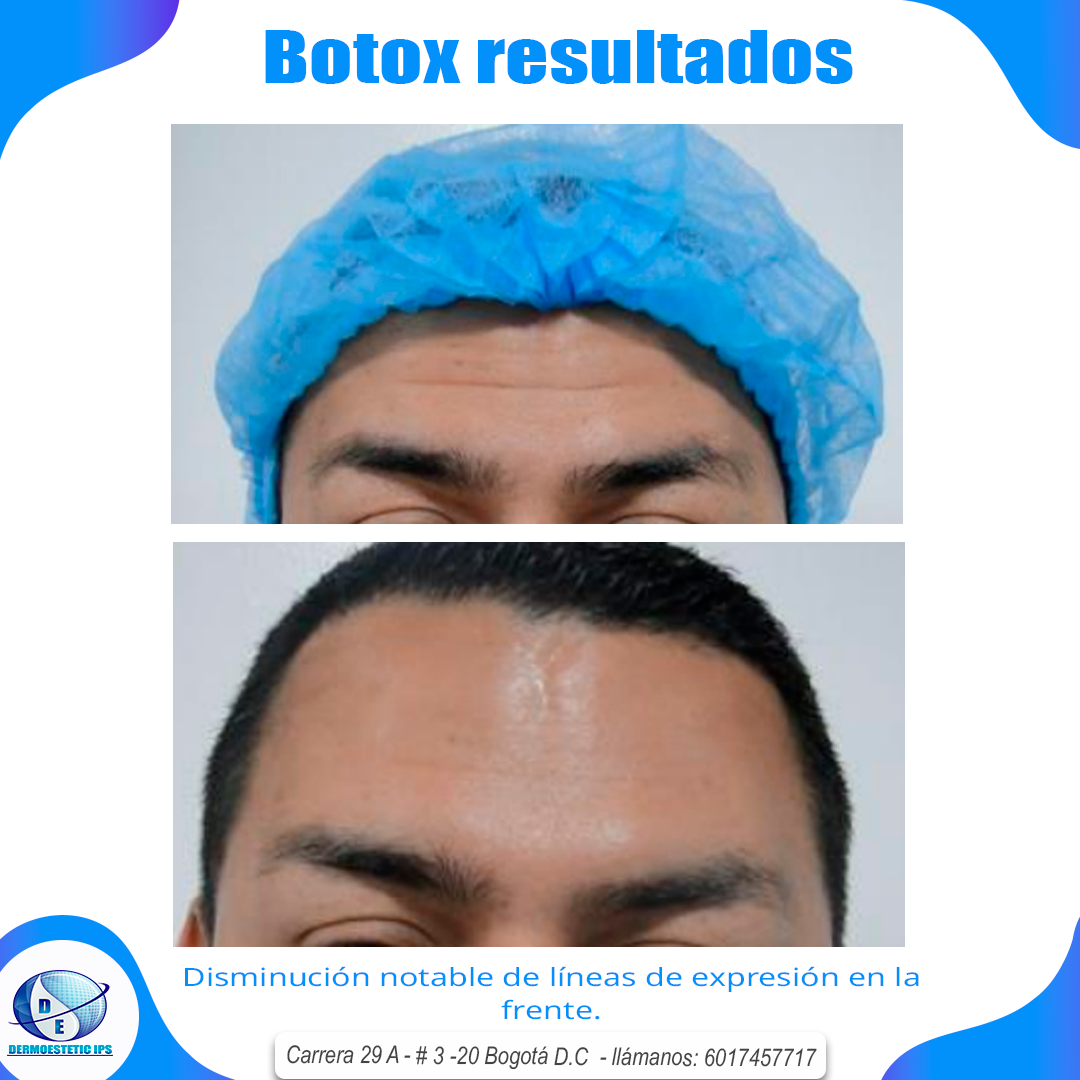 Una foto de la frente de un hombre antes y después del botox.