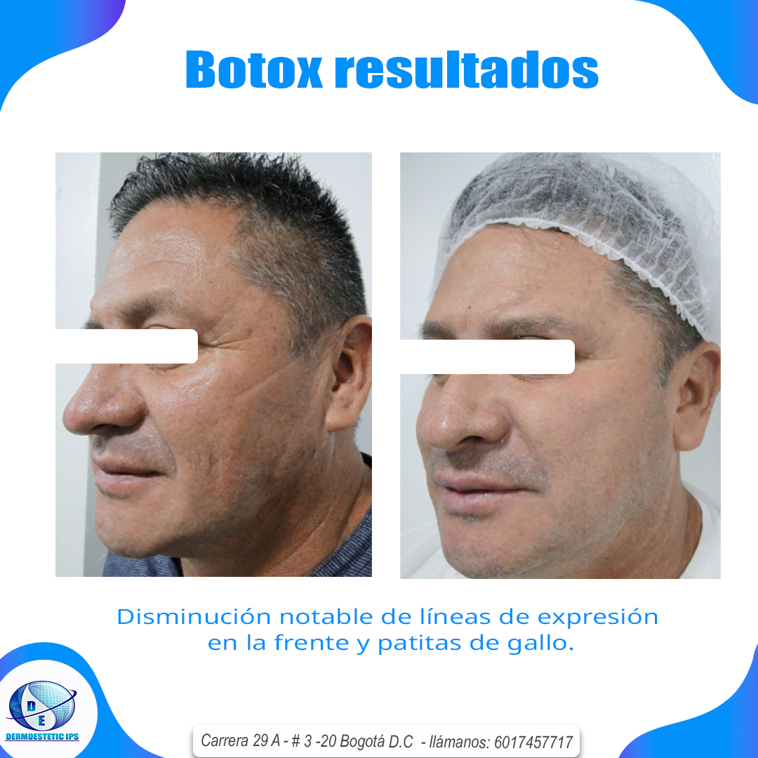 Una foto de antes y después de un hombre con resultados de botox.